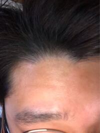 ハゲがなおるってすごくないですか 職場の上司なんですが 前は完全にハゲかけてい Yahoo 知恵袋