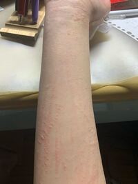最近 腕とか掻くと蕁麻疹 ミミズ腫れ 的なものが出来ます ムヒなど痒み Yahoo 知恵袋