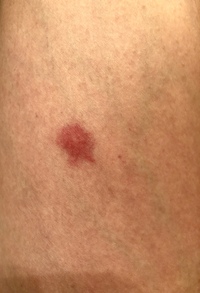 何の虫刺されか分かりますか 太ももの内側で 直径15mmくらいです 最初 Yahoo 知恵袋