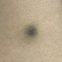 画像注意 背中に黒い出来物があります 特に盛り上がっているわ Yahoo 知恵袋
