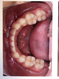 歯科矯正で上下合わせて4本の永久歯を抜いたのですが 何番目の歯 Yahoo 知恵袋