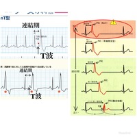 外収縮 心電図の読み方について 心臓に問題の期外収縮持ちで 二段脈もよく Yahoo 知恵袋