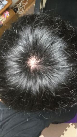 コンプリート 赤ちゃん 後頭部 はげ 赤い 赤ちゃんの画像無料