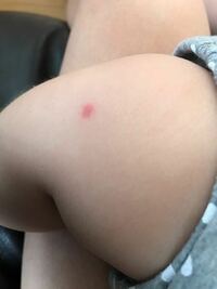 この湿疹は何か分かりますか 赤ちゃんの顔 腕 足に四つ出 Yahoo 知恵袋