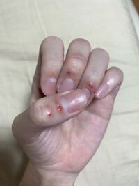 皮めくれ ささむけ 指先がこんな感じで もう一ヶ月程改善しませ Yahoo 知恵袋