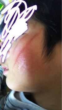 子供がスイミングに通ってるのですが顔に怪我をして帰ってきました 明 Yahoo 知恵袋