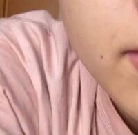 19歳です 口の横にある茶色シミがあるんですけど 原因はなんでしょうか Yahoo 知恵袋