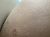 恥ずかしながら お尻の内側 太腿の内腿にこのような湿疹ができました 普段 Yahoo 知恵袋