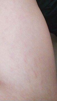 謎の内出血 について汚い画像すみません 1か月前位から 太もも Yahoo 知恵袋