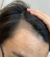 これはm字はげですか 高2男子です 中学の頃に自分の生え際を意識し Yahoo 知恵袋