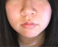 閲覧注意かもです 写真あり 鼻より下 口周りの肌荒れが酷い Yahoo 知恵袋