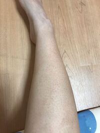 汚い写真です閲覧注意です ここ数年悩んでるのですが 脚に Yahoo 知恵袋