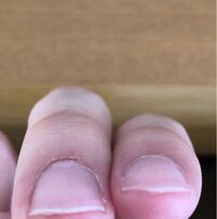 爪と爪を繋ぐ皮膚に隙間ができてしまいました 左側の指です 右側の指と比 Yahoo 知恵袋
