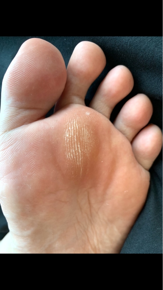 水虫 すべての質問 Yahoo 知恵袋