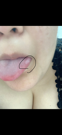 舌癌 一昨日ぐらいから痛みがあり 鏡で見た所 白い物ができてました 舌癌 Yahoo 知恵袋