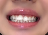 歯並びが悪く 特に前歯のすきっ歯が気になります この状態では誰 Yahoo 知恵袋