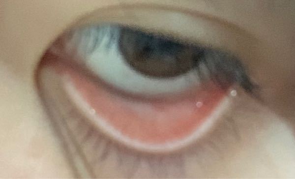 貧血かわかる方法で 目の下の皮膚が白いと貧血と言いますが これは白いです Yahoo 知恵袋