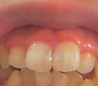 朝起きたら急に前歯の一部が白くなりました 昨晩 歯磨きを念入り Yahoo 知恵袋