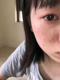 高校1年生女子です 中学生の頃ストレスてニキビができてか Yahoo 知恵袋