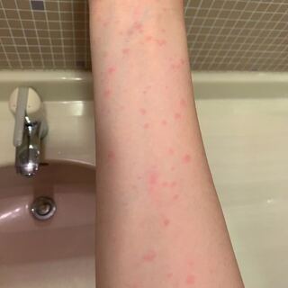 このような赤い斑点が昨日の夜全身に起きました痒いです 昨日の夜は中華 Yahoo 知恵袋