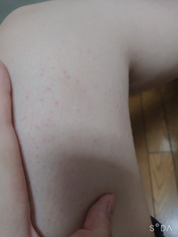 太ももの内側や すね 二の腕などにブツブツのようなものができ Yahoo 知恵袋