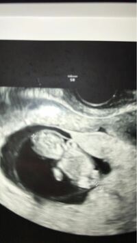 妊娠11週の時のエコー写真です 性別判定できますか Yahoo 知恵袋