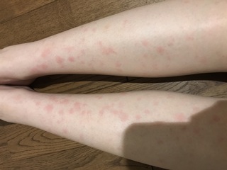 かゆい お風呂上がり 赤い斑点