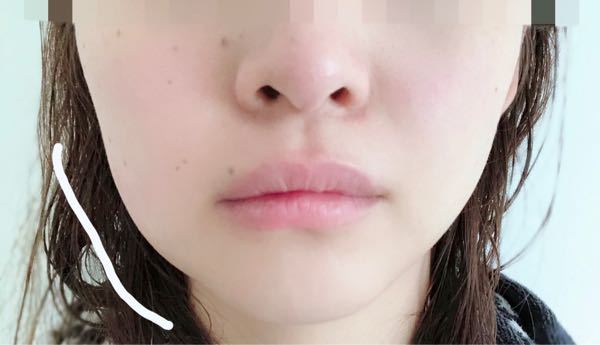 虫歯治療親知らず腫れ頬の腫れ 下の奥歯の虫歯治療後 約一週 Yahoo 知恵袋