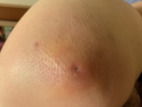 これは粉瘤でしょうか 数日前からお尻にしこりみたいなのが大きくあり痛くて Yahoo 知恵袋