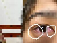 閲覧注意です 結膜浮腫になってしまったので１時間ほど Yahoo 知恵袋