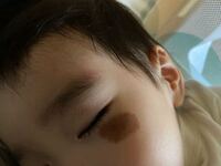 子供の顔のあざについて 現在１歳4ヶ月の息子ですが 生ま Yahoo 知恵袋