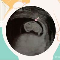 赤ちゃんの首の後ろの浮腫について 妊娠9w2dの診察でエコー写真を見 Yahoo 知恵袋