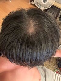 26歳男性です 高校時代から髪の毛が細くつむじが広いと言われてきました Yahoo 知恵袋