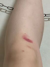 これは何に刺された可能性が高いですか 毎回虫刺されになると内出血み Yahoo 知恵袋