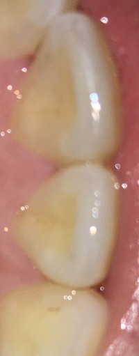 この様な歯の裏側の黄ばみはpmtcで落とせるのでしょうか タバ Yahoo 知恵袋