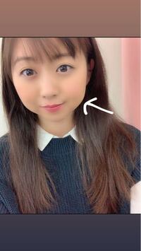 写真の矢印の下頬肉をなくすには 脂肪吸引ですか バッカルファッ Yahoo 知恵袋