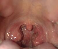 この喉は腫れてますか 扁桃炎と診断されました 昨日まで高 Yahoo 知恵袋