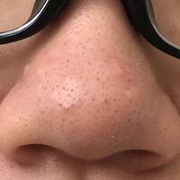 写真汚いです いちご鼻と角栓がひどいです ホホバオイルでたまにく Yahoo 知恵袋