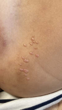 幼児の湿疹 についてです 写真のような出来物が おむつの当たる部分 Yahoo 知恵袋