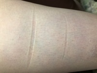 娘の太ももに不思議な線が現れます 現在17歳 15歳くらいから 突然太も Yahoo 知恵袋