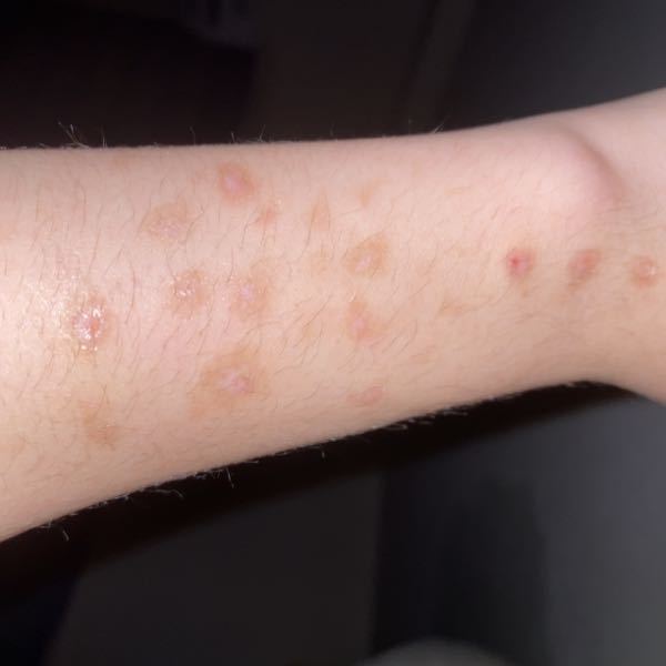 引っ掻き傷なのですが - この傷跡はアットノンなどのクリームを 