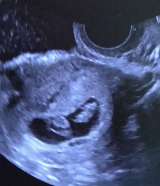 双子の妊娠妊娠7週目の妊婦です昨日二回目の健診でエコーを見たら双子だと言 Yahoo 知恵袋
