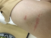 太ももに痒みがあり 虫さされのような物ができました これは帯状 Yahoo 知恵袋