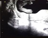 17週のエコー写真です 男の子か女の子かわかる方いらっしゃいますで Yahoo 知恵袋