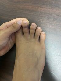 反復横跳びしてて 足の指がまっがって 黒くなったのですが 捻挫ですか Yahoo 知恵袋