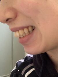 歯科矯正の後戻りの出っ歯です 再矯正は可能でしょうか 1 Yahoo 知恵袋