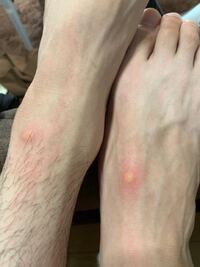 虫刺され画像あり この虫刺されは何の虫が原因でしょうか 家の中に蚊は Yahoo 知恵袋
