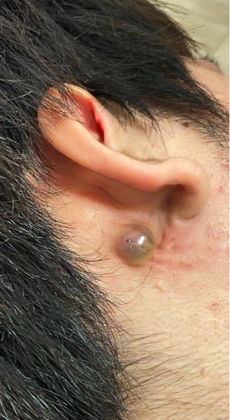 黒いしこり に関するq A Yahoo 知恵袋