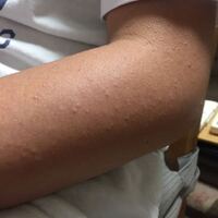 子供の腕のブツブツが一向に良くなりません 肩から手首にかけ全体的に満遍な Yahoo 知恵袋