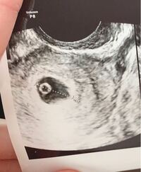 先日妊娠5週5日で胎嚢確認出来ました 胎嚢は13 5ミリ Yahoo 知恵袋